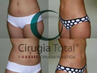 Cl Nicas De Lipoescultura En Xalapa Enr Quez Multiestetica Mx