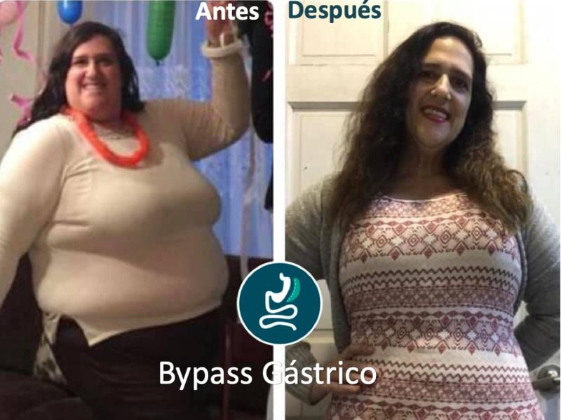 Bypass G Strico Antes Y Despu S Multiestetica Mx Multiestetica Mx