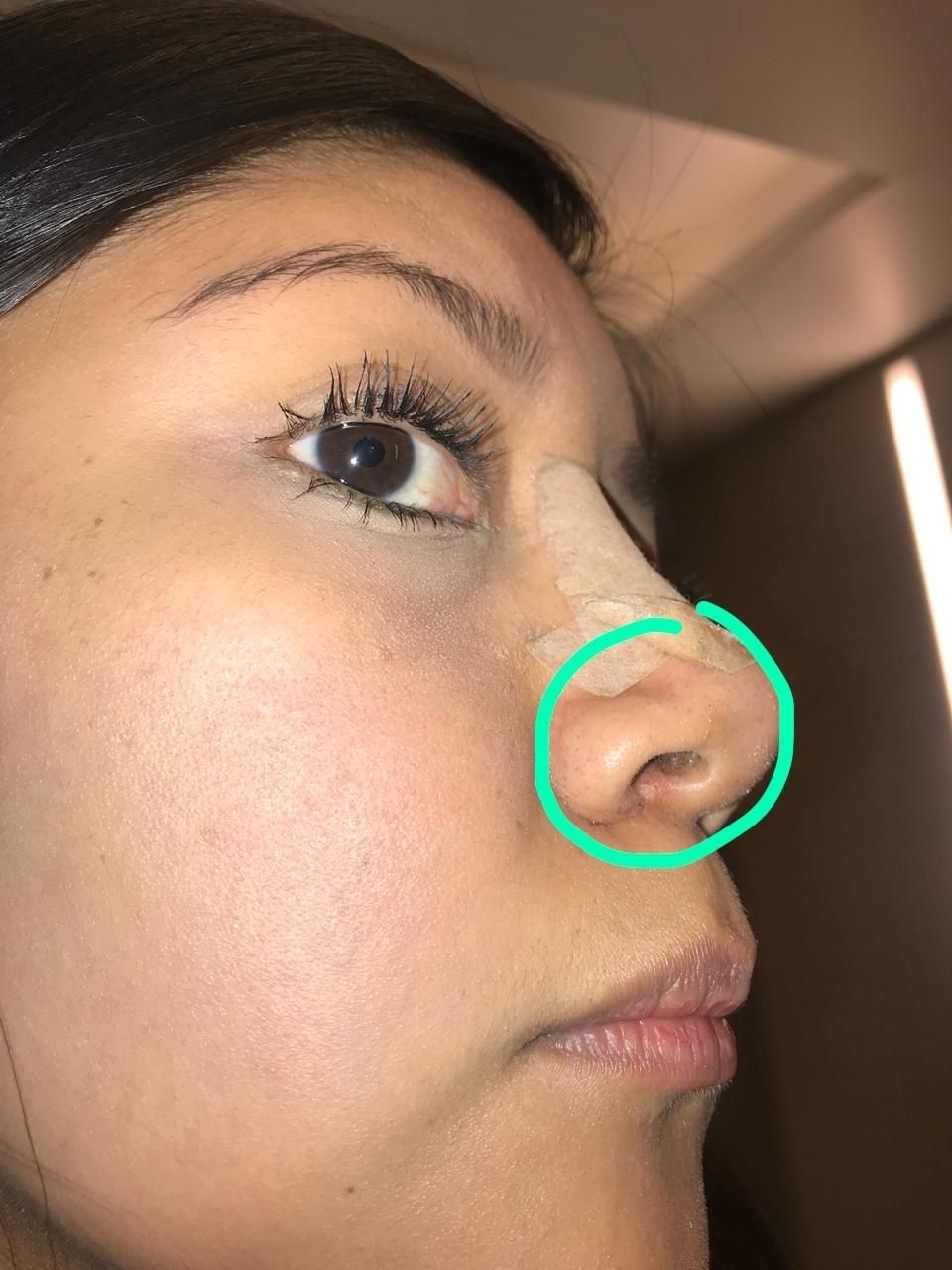 A casi 3 meses de la cirugía Rinoplastia Multiestetica mx