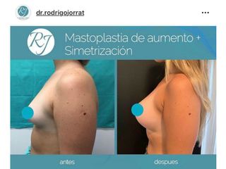 mastoplastia de aumento + simetrización 1