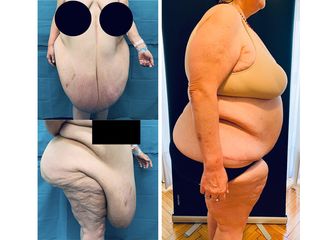Abdominoplastia - Dr. Rodrigo Jorrat