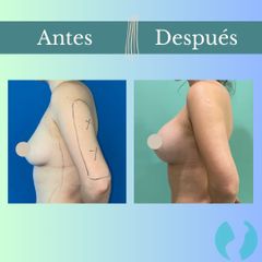 Aumento mamario - Clinica Essenza