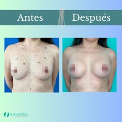 Aumento mamario - Clinica Essenza