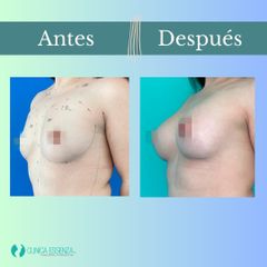 Aumento mamario - Clinica Essenza