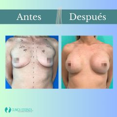 Aumento mamario - Clinica Essenza