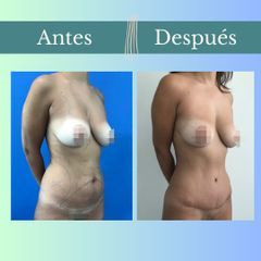 Abdominoplastia - Clinica Essenza