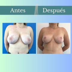 Reducción mamaria - Clinica Essenza