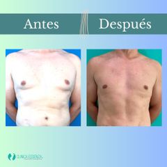 Ginecomastia - Clinica Essenza