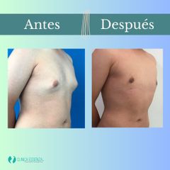 Ginecomastia - Clinica Essenza