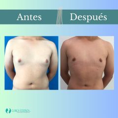 Ginecomastia - Clinica Essenza