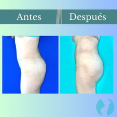 Aumento glúteos - Clinica Essenza