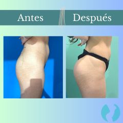 Aumento glúteos - Clinica Essenza