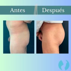 Aumento glúteos - Clinica Essenza