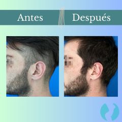 Otoplastia - Clinica Essenza