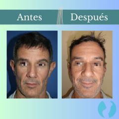 Otoplastia - Clinica Essenza