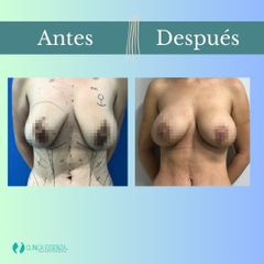 Mastopexia - Dr. Vicente Sánchez Liberona