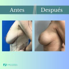 Mastopexia - Dr. Vicente Sánchez Liberona