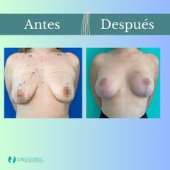 Mastopexia - Dr. Vicente Sánchez Liberona