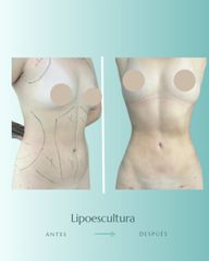 Liposuccion - Dr. Vicente Sánchez Liberona