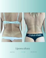 Lipoescultura - Dr. Vicente Sánchez Liberona