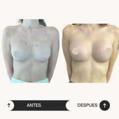 Aumento Mamario  -Dr. Vicente Sánchez Liberona