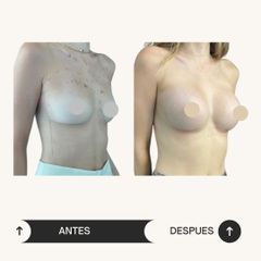 Aumento Mamario - Dr. Vicente Sánchez Liberona