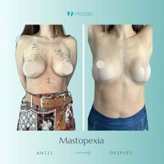 Mastopexia - Dr. Vicente Sánchez Liberona