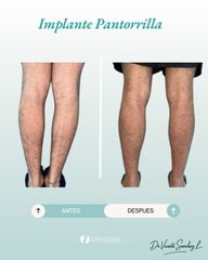 Implante Pantorrilla - Dr. Vicente Sánchez Liberona