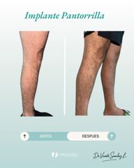 Implante de Pantorrilla - Dr. Vicente Sánchez Liberona