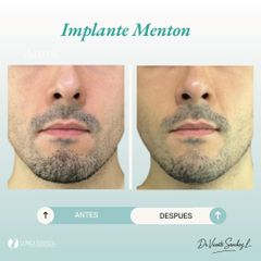 IMPLANTE DE MENTON - Dr. Vicente Sánchez Liberona