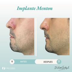 IMPLANTE DE MENTON - Dr. Vicente Sánchez Liberona