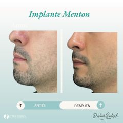 IMPLANTE DE MENTON - Dr. Vicente Sánchez Liberona