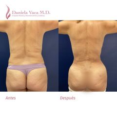 Liposucción - Dra. Daniela Stephania Vaca Grisales