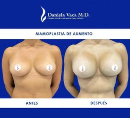 Mamoplastia de aumento - Dra. Daniela Stephania Vaca Grisales