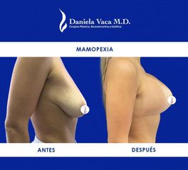 Mamopexia - Dra. Daniela Stephania Vaca Grisales
