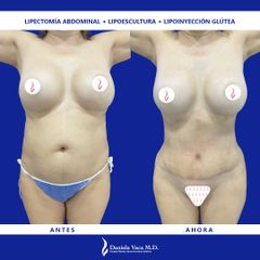 Lipectomía - Dra. Daniela Stephania Vaca Grisales