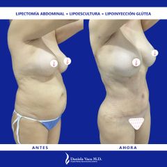 Lipectomía - Dra. Daniela Stephania Vaca Grisales
