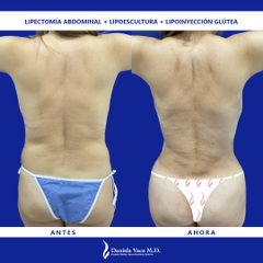 Lipectomía - Dra. Daniela Stephania Vaca Grisales