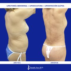 Lipectomía - Dra. Daniela Stephania Vaca Grisales