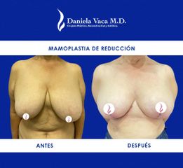 Mamoplastia de reducción - Dra. Daniela Stephania Vaca Grisales
