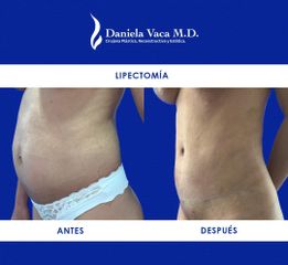 Lipectomía - Dra. Daniela Stephania Vaca Grisales