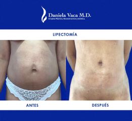 Lipectomía - Dra. Daniela Stephania Vaca Grisales