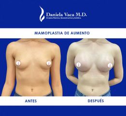 Mamoplastia de aumento - Dra. Daniela Stephania Vaca Grisales