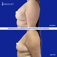 Mamoplastia de reducción - Dra. Daniela Stephania Vaca Grisales