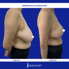 Mamoplastia de reducción - Dra. Daniela Stephania Vaca Grisales