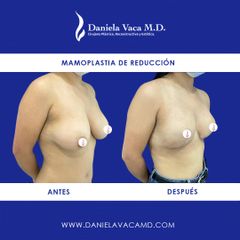 Mamoplastia de reducción - Dra. Daniela Stephania Vaca Grisales