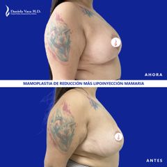 Mamoplastia de reducción - Dra. Daniela Stephania Vaca Grisales
