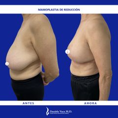 Mamoplastia de reducción - Dra. Daniela Stephania Vaca Grisales