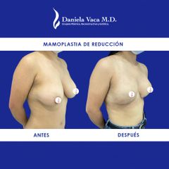 Mamoplastia de reducción - Dra. Daniela Stephania Vaca Grisales