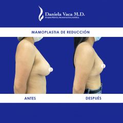 Mamoplastia de reducción - Dra. Daniela Stephania Vaca Grisales